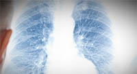 Radiology image from a lung cancer screening