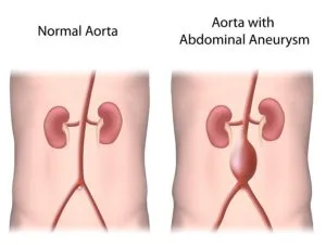 normal aorta versus aorta with bulging aneurysm