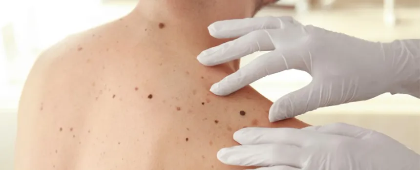 A health care worker's hands with vinyl gloves on are on a man's shoulder where there are various moles of different sizes and colors.